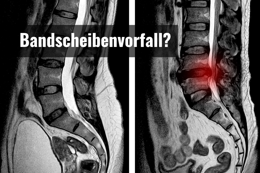 Bandscheibenvorfall Warstein Rückenschmerzen Chris Eikelmeier