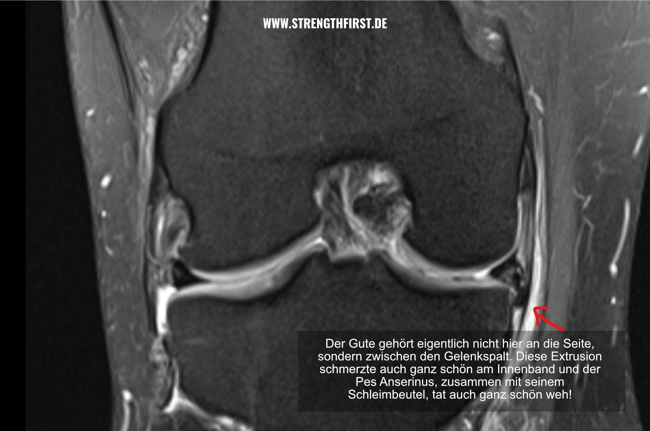 Innenmeniskusriss Meniskusriss Physiotherapie Warstein