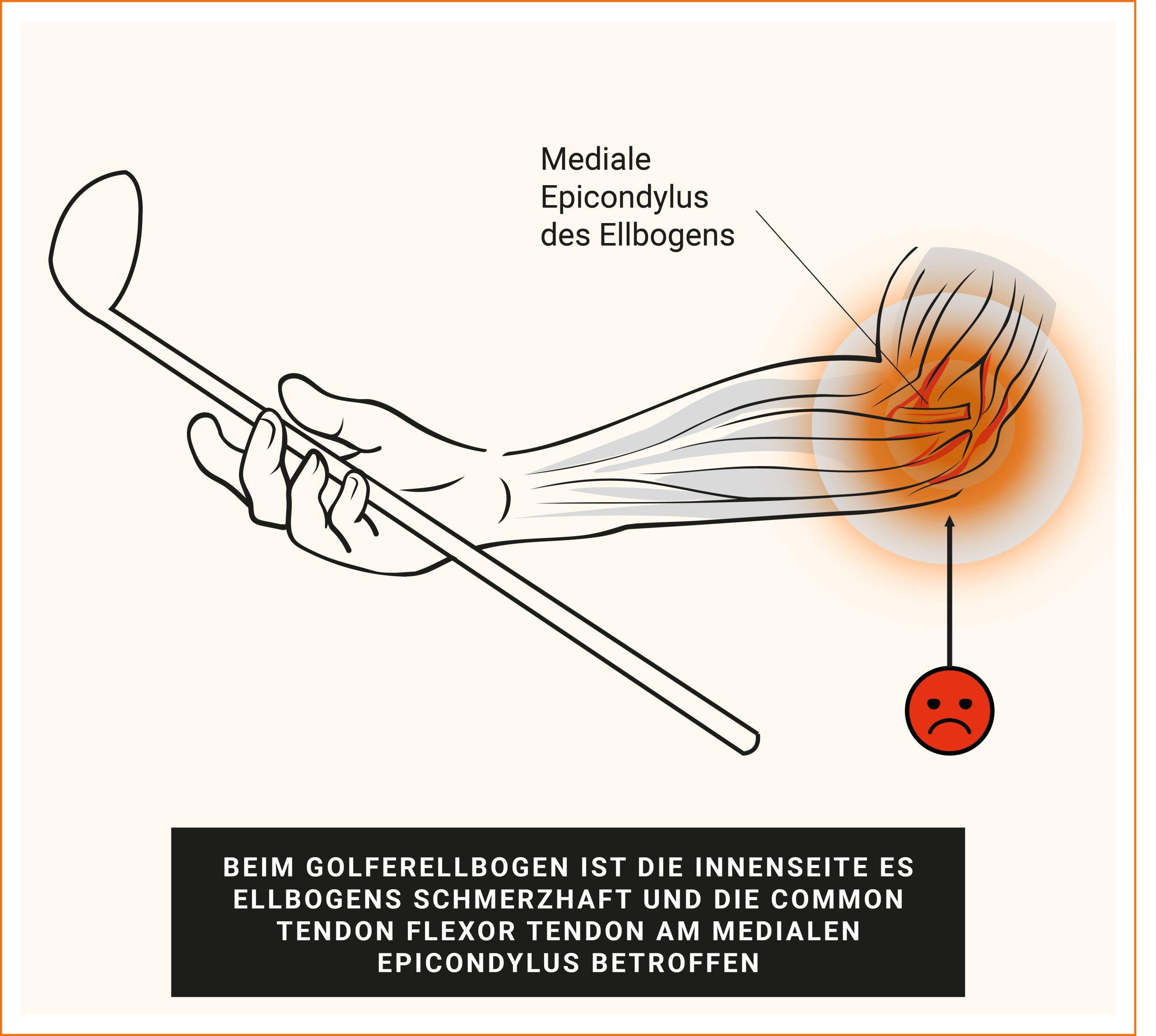 Golferellbogen Common flexor tendon