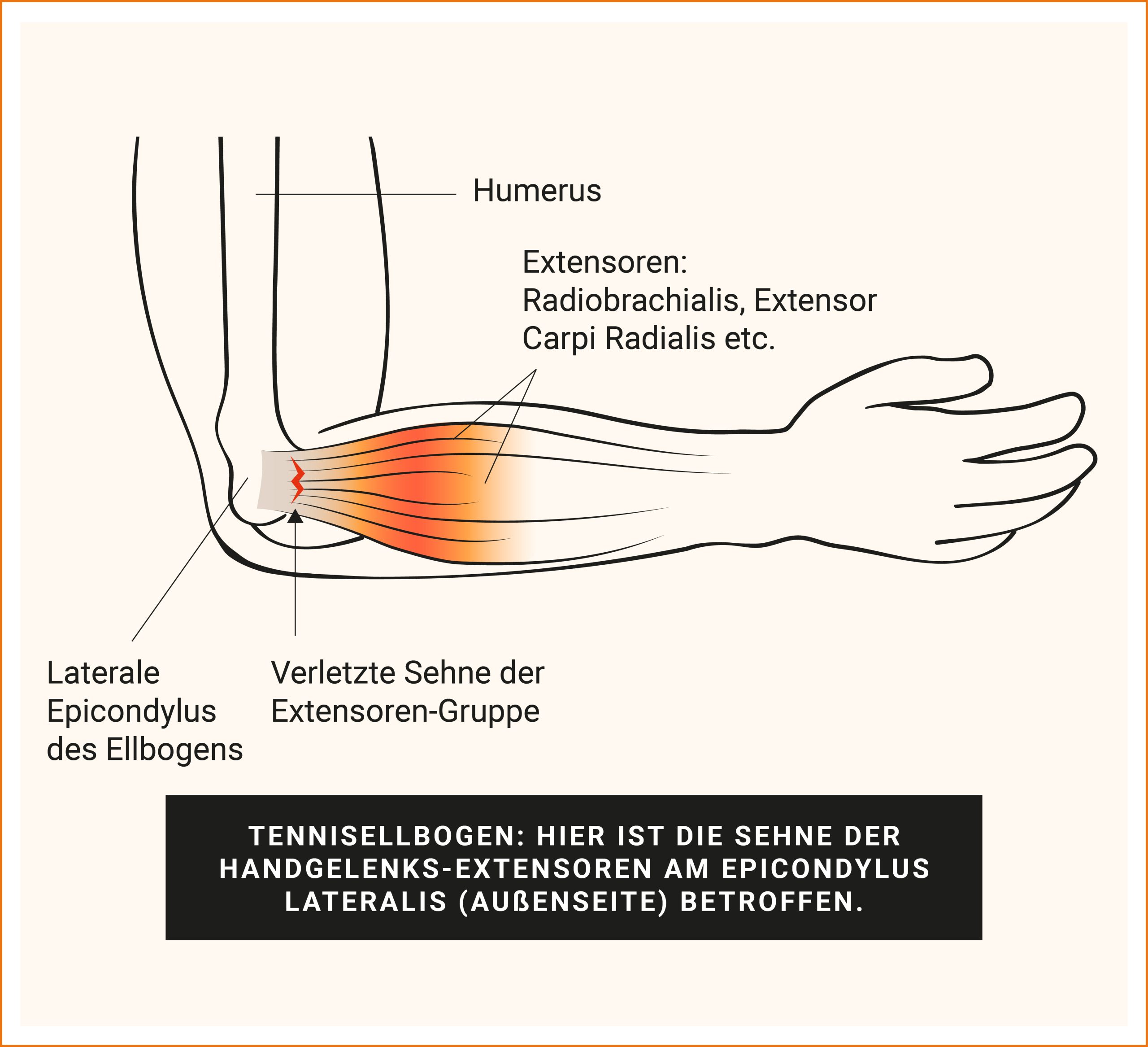 Tennisellbogen Muskelgruppe